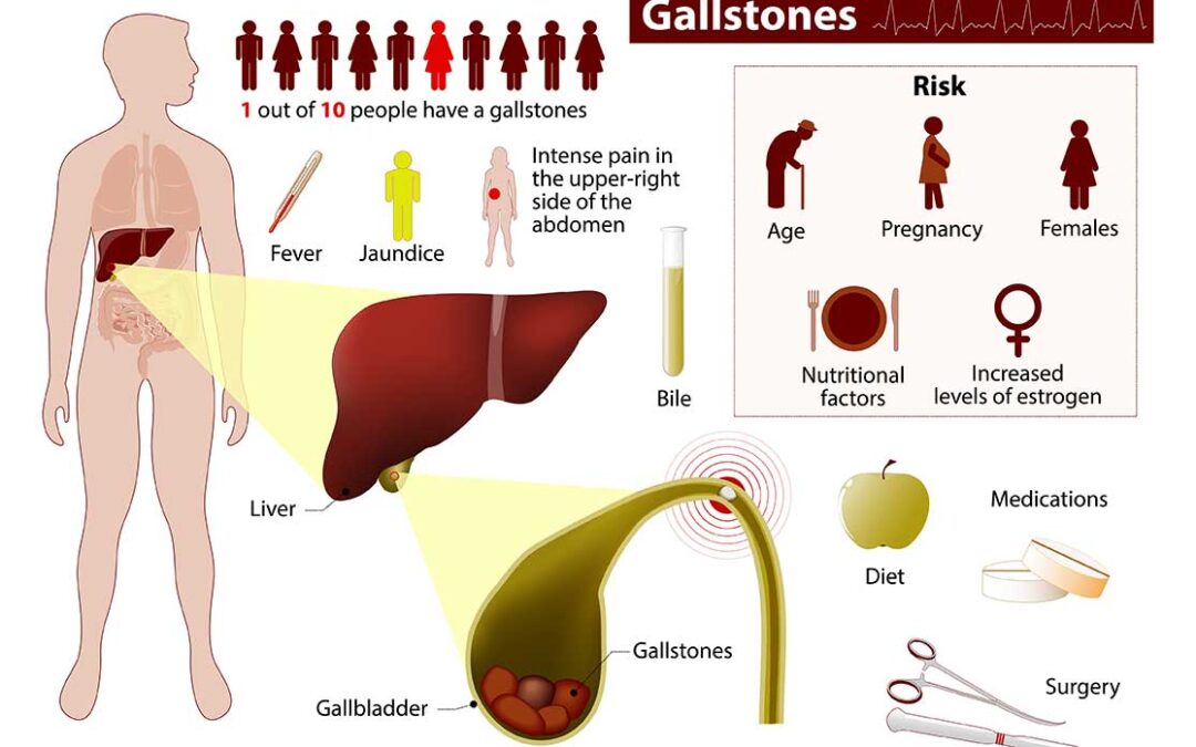 A Guide to Gallstones