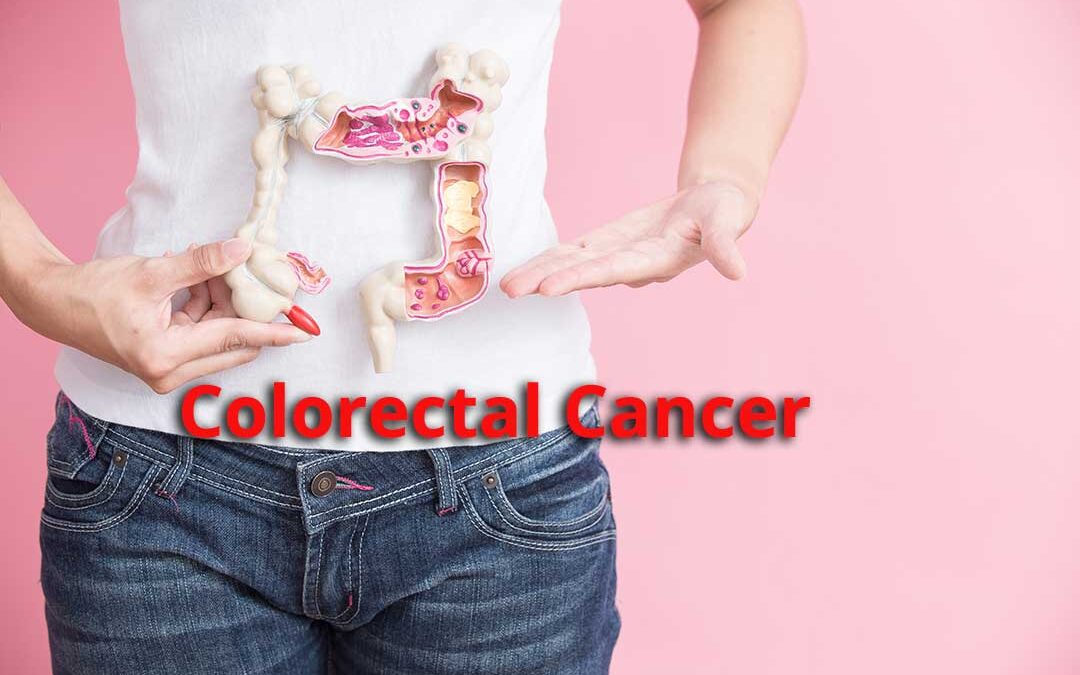 What are the Warning Signs and Treatment Options for Colorectal Cancer?